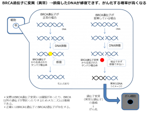 BRCA遺伝子変異