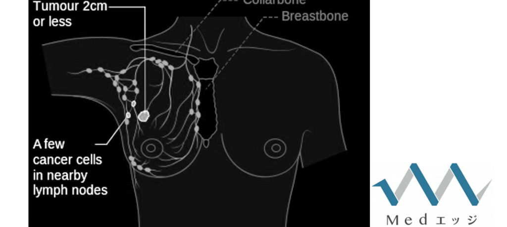 乳がんサバイバーで体重増加が問題に、家系的リスクのある女性を対象にした調査