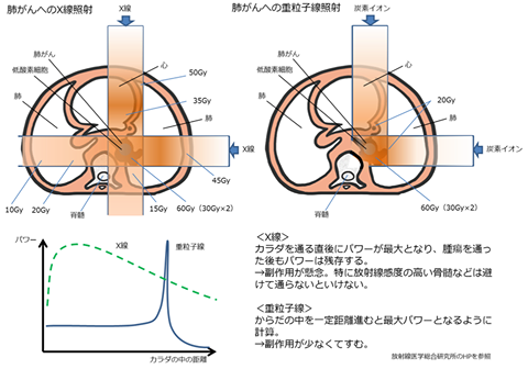 オンコロブログ20150513　重粒子治療って