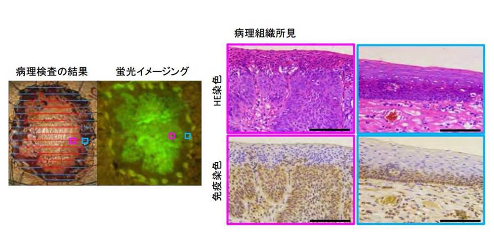 がんを光らせるスプレー、食道がん識別に成功