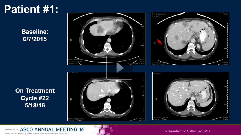 転移性肛門がん対象 オプジーボの第2相臨床試験 病勢コントロール率70％ ASCO2016