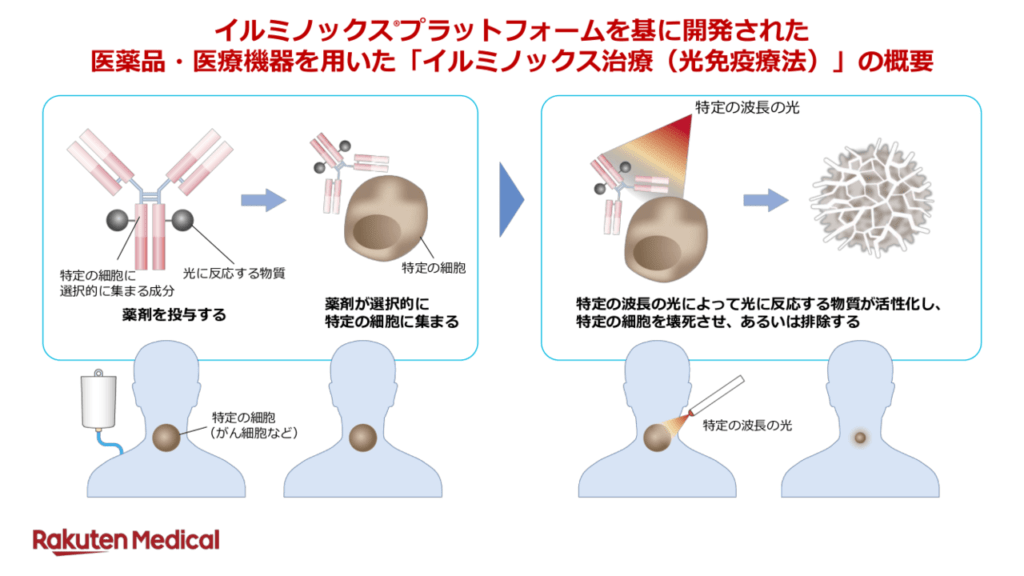 頭頸部がんに条件付き承認の「光免疫療法」 他のがん種や全身療法への応用を目指す臨床試験も進行中